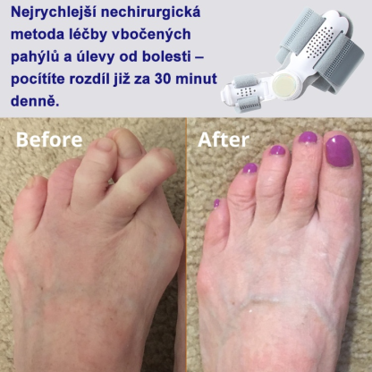 ✨Strážce zdraví palce: korektor valgózní deformace🏆
