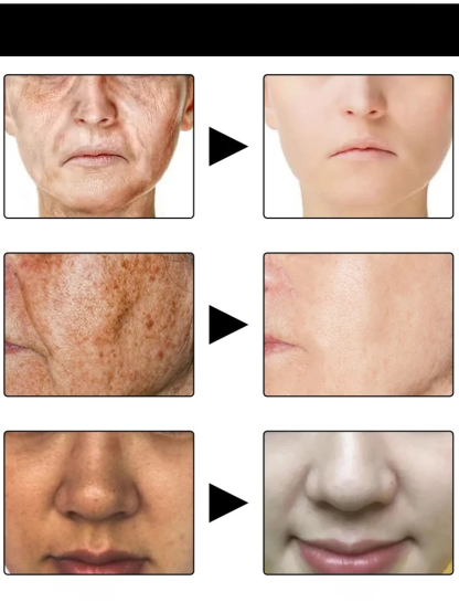 🔬Recommended by Harvard dermatologists! Fast-acting Whitening and Spot-dissolving Essence🌟 Fades sun spots/acne scars in 7 days ✅ No irritation, no rebound darkening