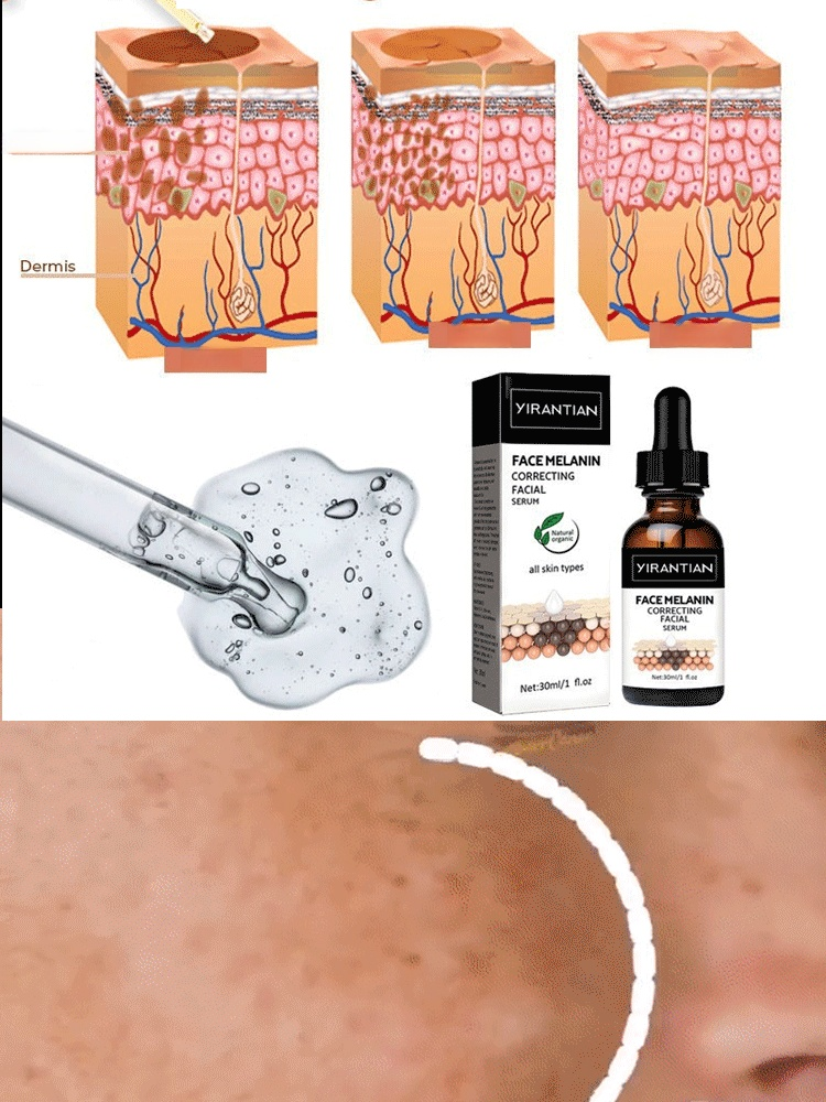 🔬Recommended by Harvard dermatologists! Fast-acting Whitening and Spot-dissolving Essence🌟 Fades sun spots/acne scars in 7 days ✅ No irritation, no rebound darkening