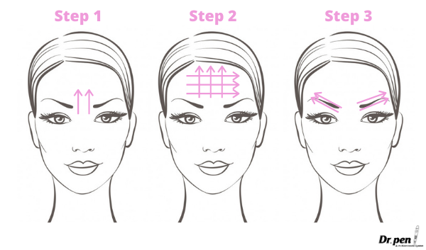 Dr Pen Face Mapping Microneedling Guide 1