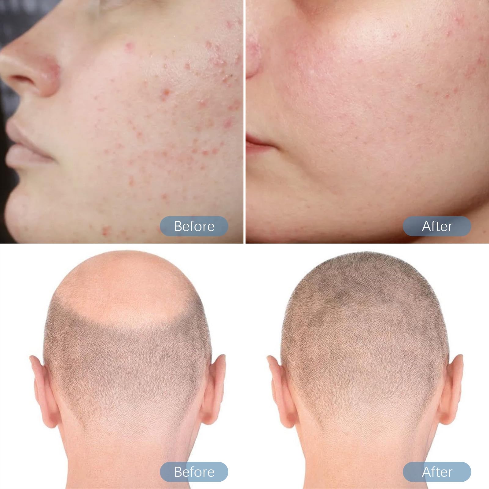 Dr Pen M8S Auto Microneedling Pen - Including 12 Pcs Replacement Cartridges