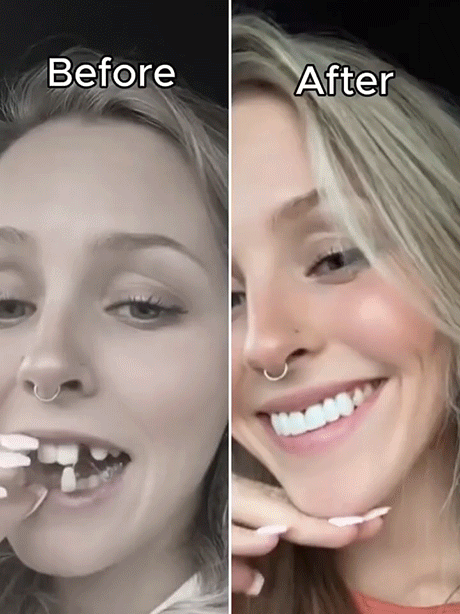 Adjustable Snap-On Dentures