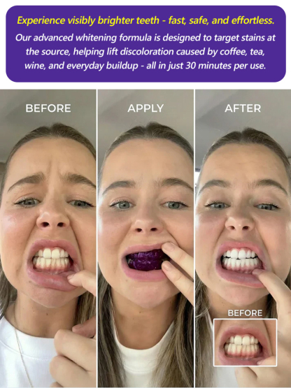 💜 Purple Magic Teeth Whitening Strips 🦷Cancel Yellow in 10 Minutes – No Pain, No Peroxide! ✨