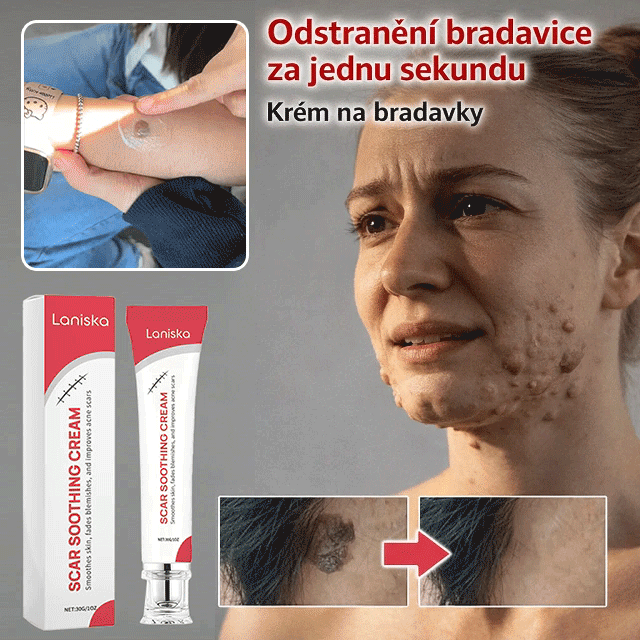 【Jednosekundový odstraňovač bradavic】Krém na odstranění bradavic