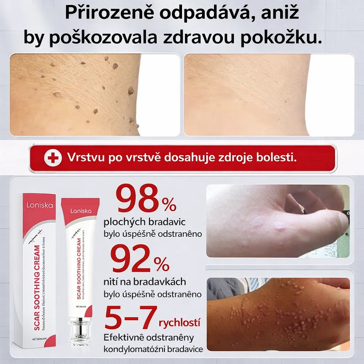 【Jednosekundový odstraňovač bradavic】Krém na odstranění bradavic