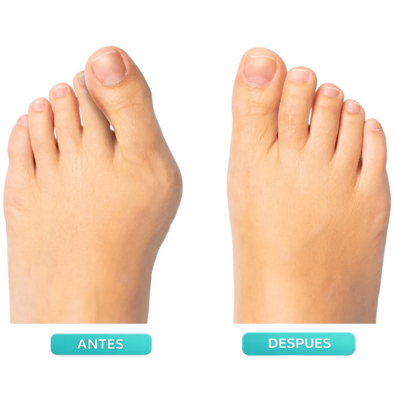 👣Adjustable Bunion Corrector