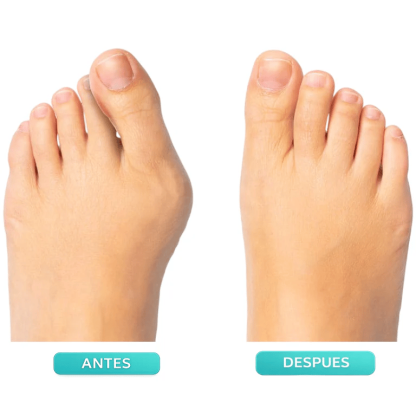 👣Adjustable Bunion Corrector