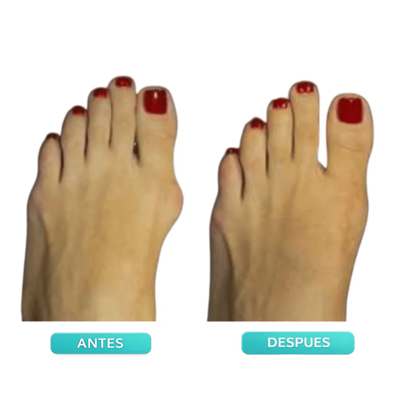 👣Adjustable Bunion Corrector