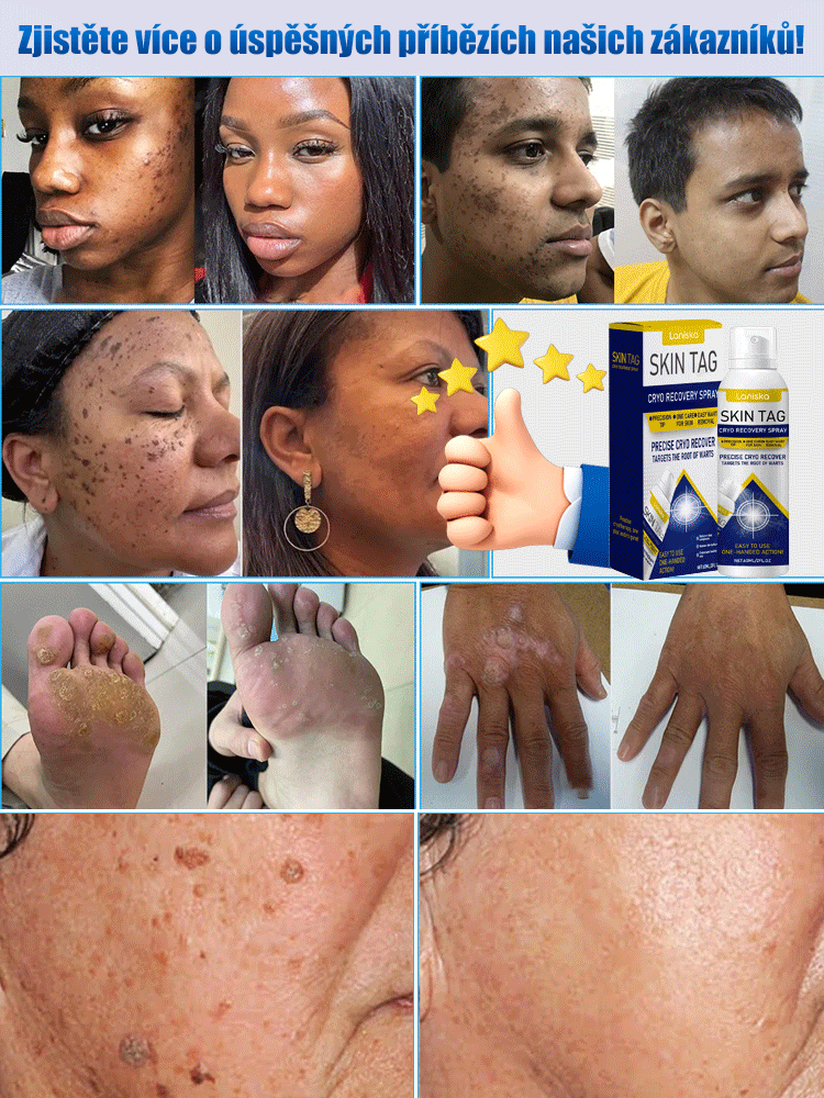 Sprej na ošetření bradavic