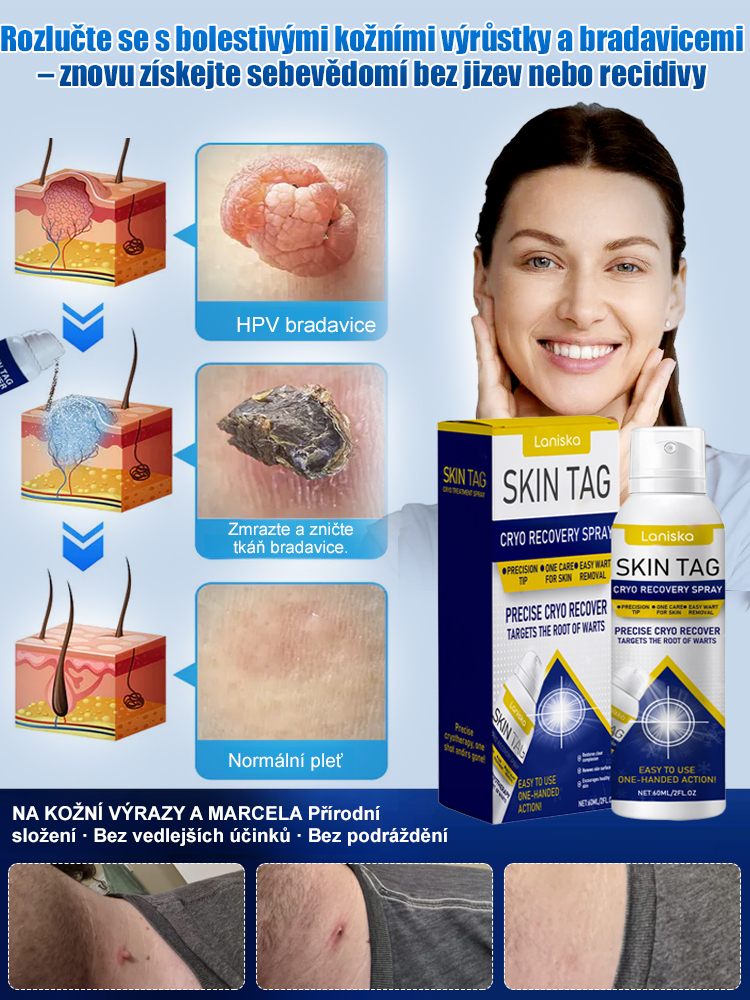 Sprej na ošetření bradavic