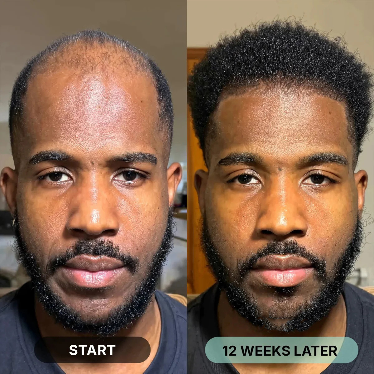 Zentra Hair Regrowth Micro-Infusion System