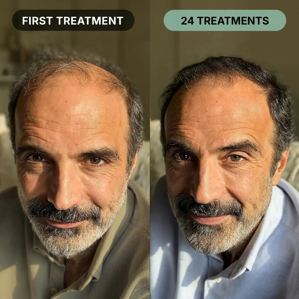 Zentra Hair Regrowth Micro-Infusion System