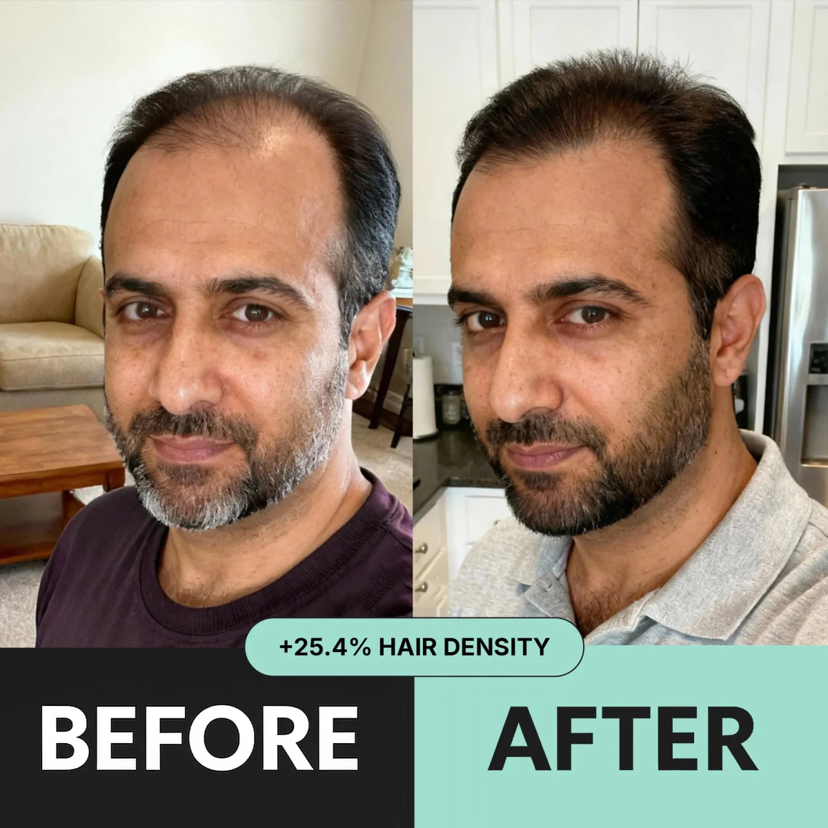 Zentra Hair Regrowth Micro-Infusion System