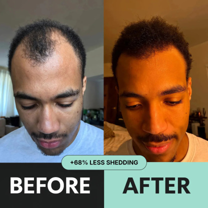 Zentra Hair Regrowth Micro-Infusion System