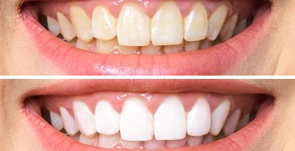 TOUT CE QUE VOUS DEVEZ SAVOIR SUR LE BLANCHIMENT DENTAIRE