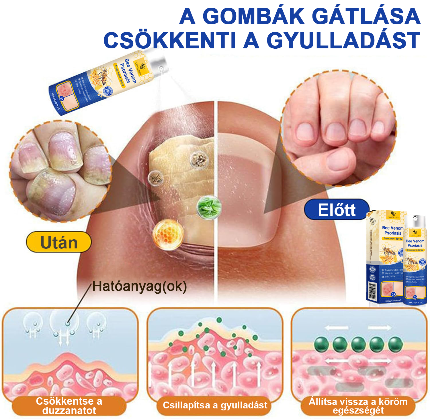 (🔥Utánvéttel🔥60% KEDVEZMÉNY) LOVILDS™ PsoriaHeal Psoriasis Spray (Szállítás világszerte – Ingyenes szállítás) 🌐