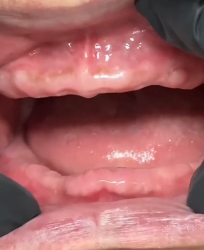 Zestaw kosmetycznych protez zębowych