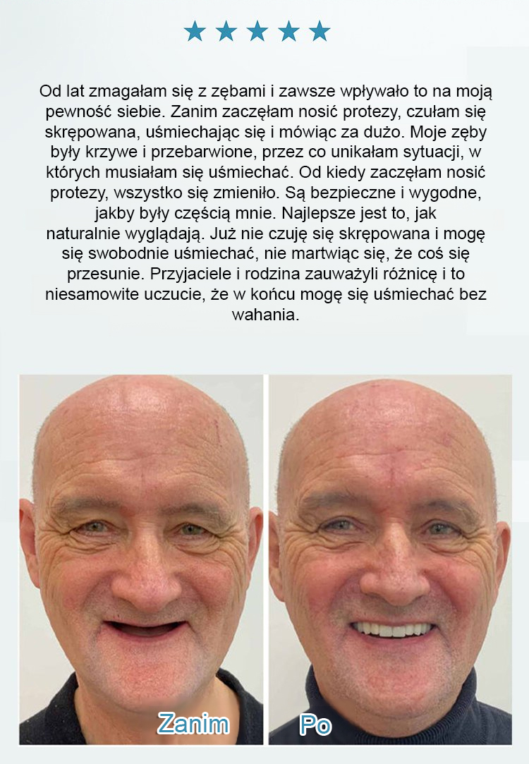 Zestaw kosmetycznych protez zębowych