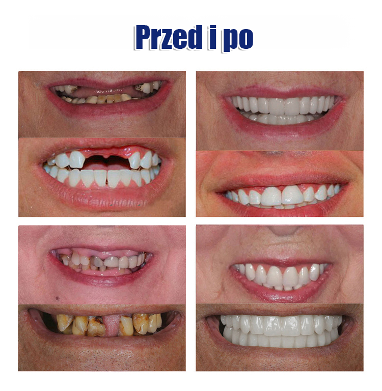 Zestaw kosmetycznych protez zębowych