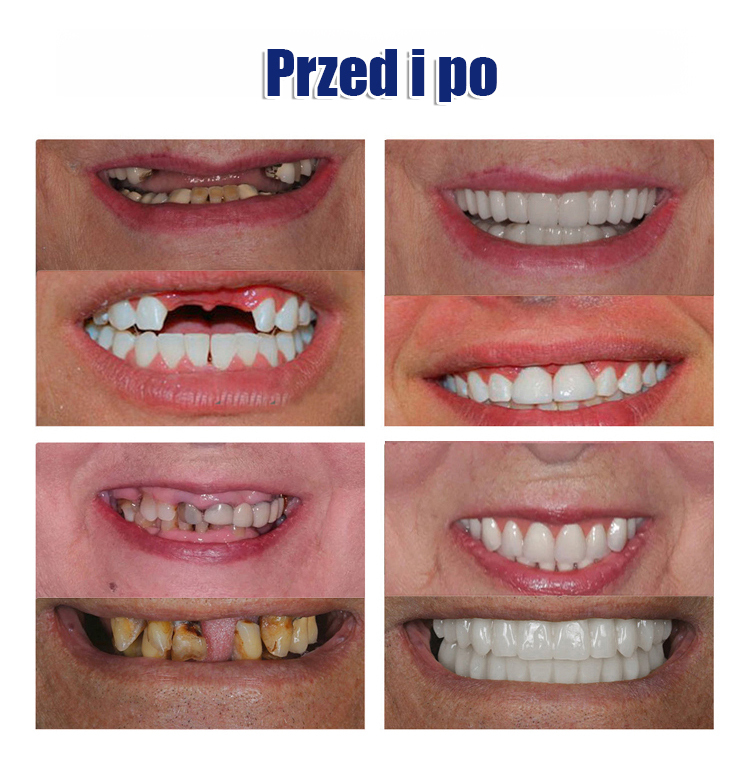 Zestaw kosmetycznych protez zębowych