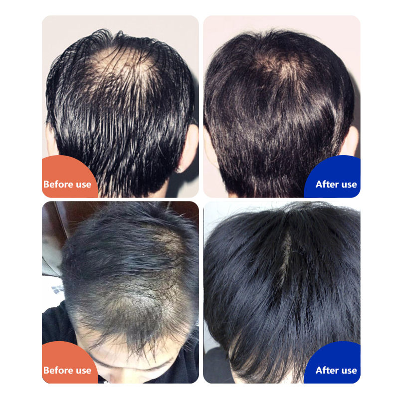 Led Hair Regrow Machine Home Use Red HatInfrared Hat Laser Caps Hairloss Cap for Hair Regrowth for Women