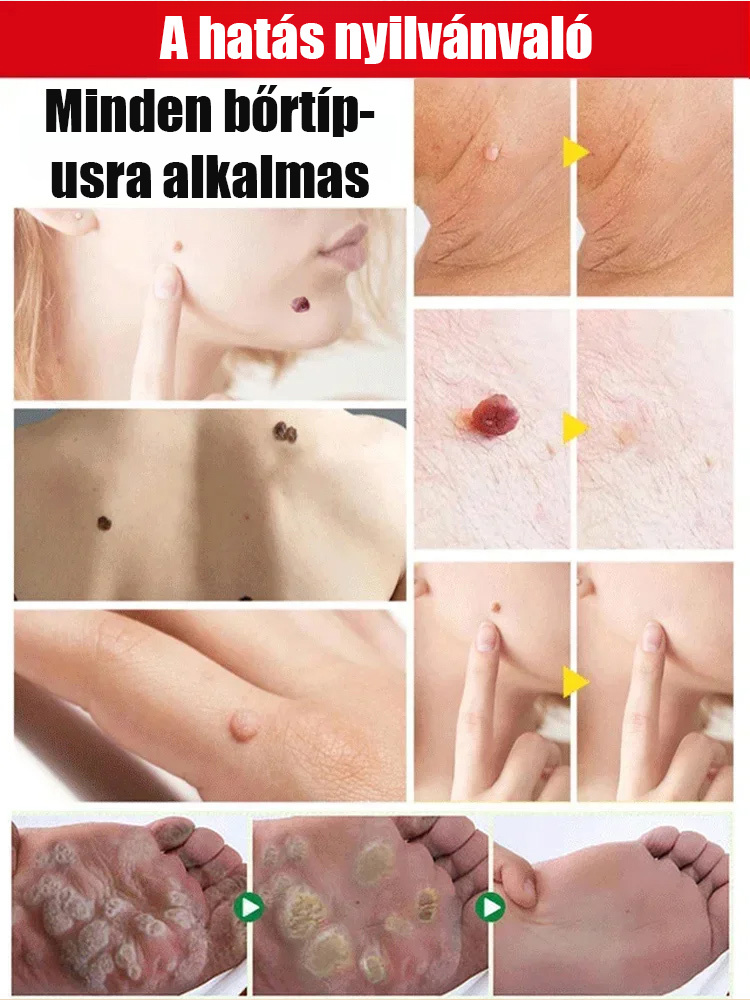 Bőrszemölcs külső ápoló permet