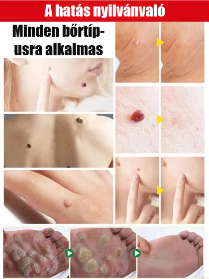 Bőrszemölcs külső ápoló permet