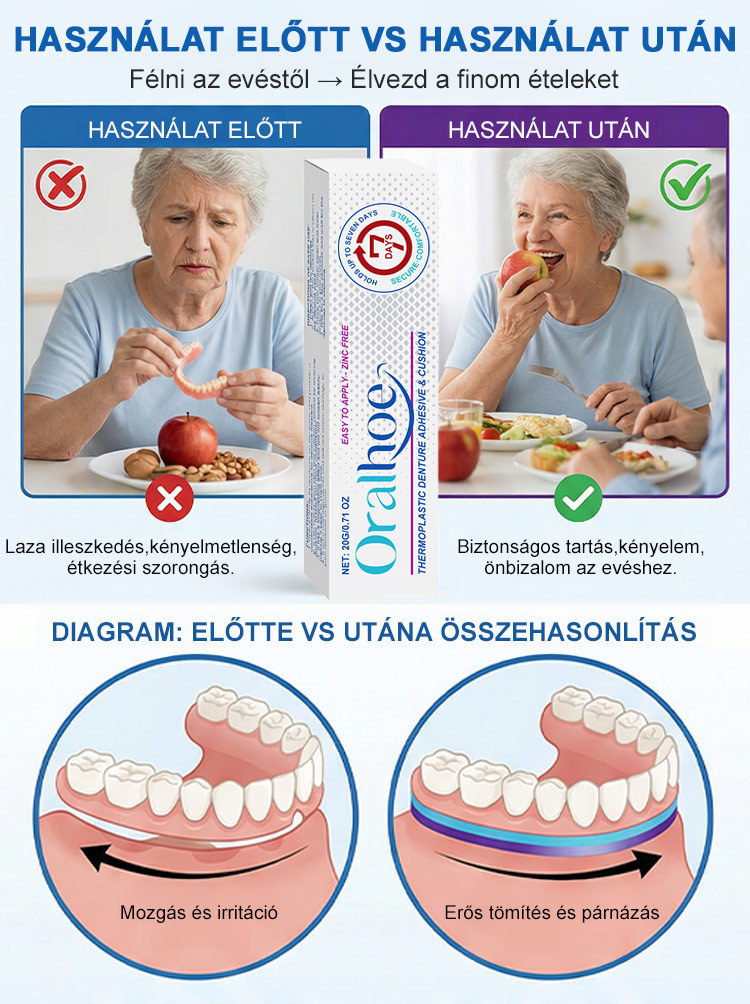 ✨ÉlelmiszeripariHőre Lágyuló Fogsor Rögzítő - 5 perc a stabil fogsorért