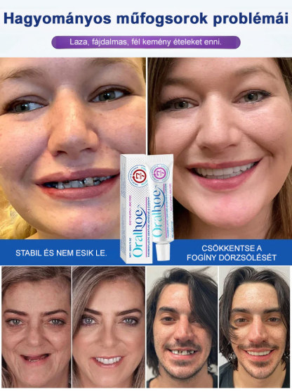 ✨ÉlelmiszeripariHőre Lágyuló Fogsor Rögzítő - 5 perc a stabil fogsorért