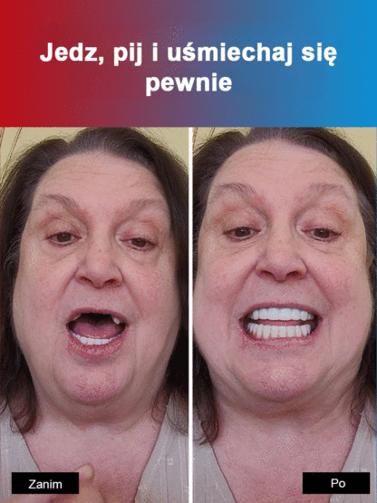  Zestaw estetycznych nakładek na zęby😁 Jedz wszystko bez obaw! Nasz zestaw nakładek pasuje idealnie, jest stabilny i daje naturalny uśmiech ✨