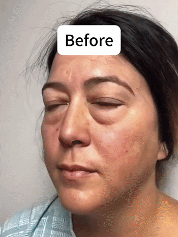 Szybki, trójfazowy plaster mikronakłuwający przeciw starzeniu i zmarszczkom