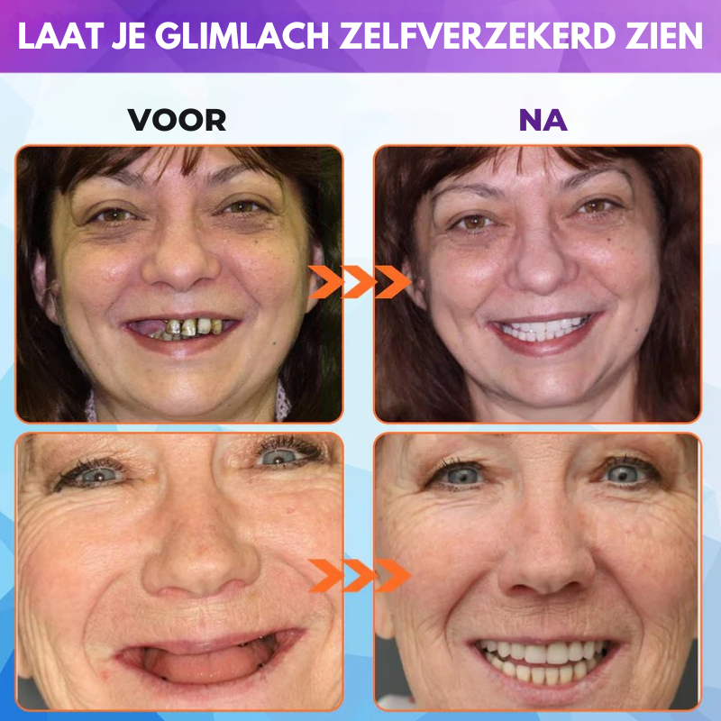 Oralhoe® Set van siliconen kunstgebitten-北京欧布科技有限公司