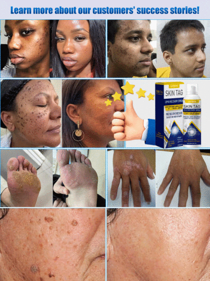 【Say Goodbye to Warts】LANISKA Wart Care Topical Spray