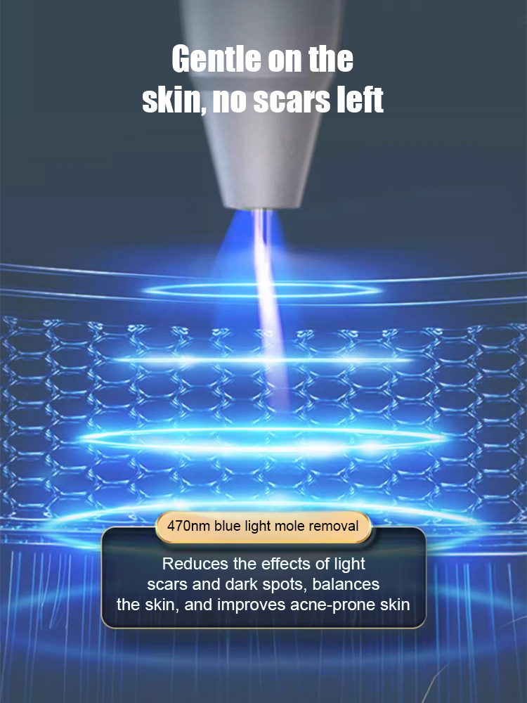 Laser painless wart removal pen