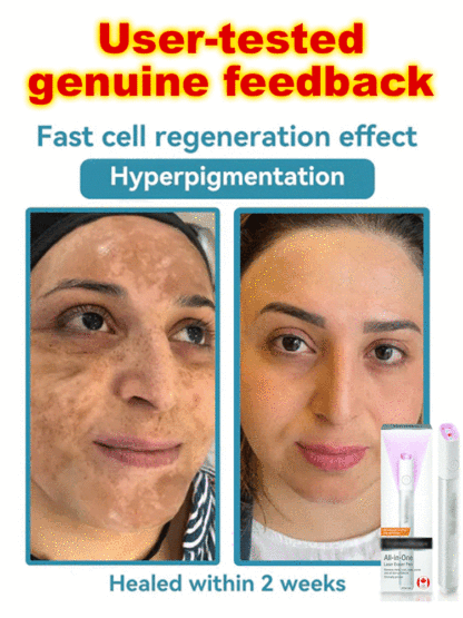 ComfortCool Painless Laser Wart Remover