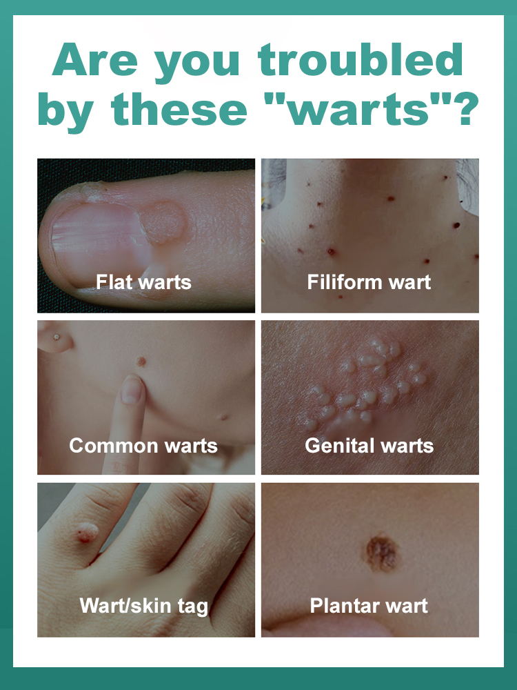 ComfortCool Painless Laser Wart Remover