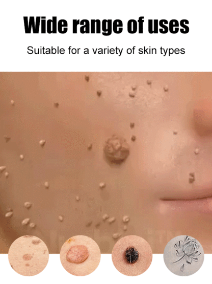 Laser painless wart removal pen