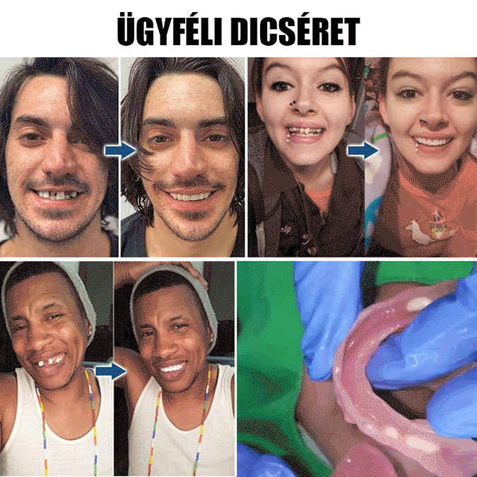 Élvezd a rágást aggodalom nélkül! 🦷 Amerikai csontszerkezet-támogató technológia 🔥 Szerezd vissza a fiatalkor harapóerejét!