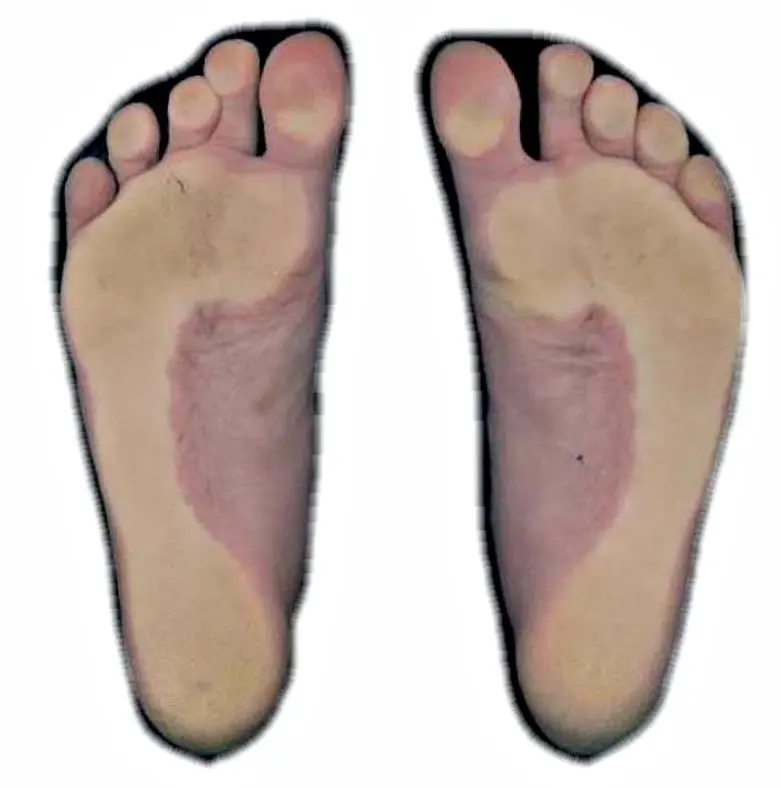 膝关节疼痛病例研究&mdash;&mdash;基于二维足部扫描的分析