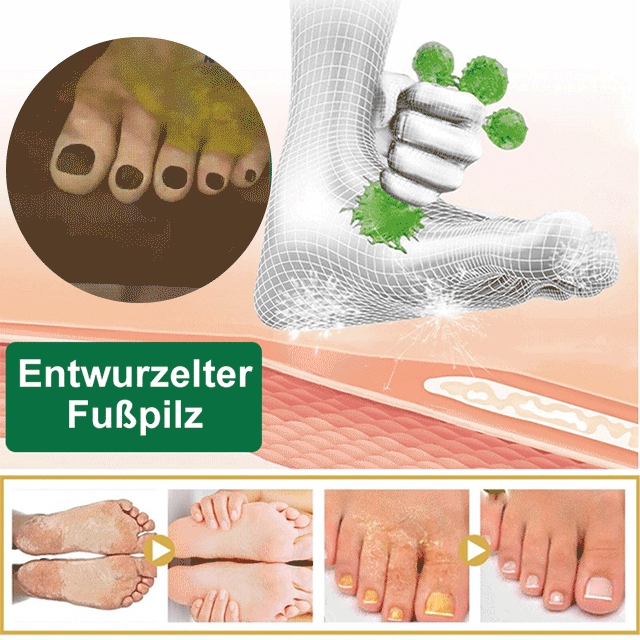 Fuß des Athleten Kräuterspray antibakteriell