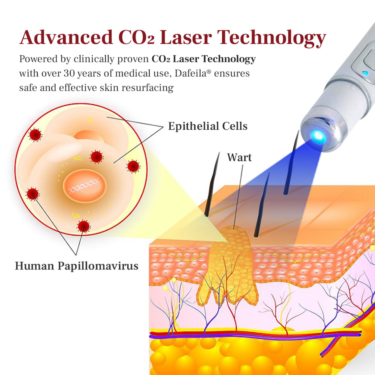 Poiultd® LumeSkin Mole and Wart Removal Laser Pen ❤️-POIULTD