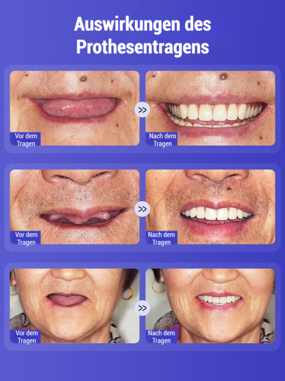 Natürlicher als echte Zähne! In 1 Sekunde angepasst, 48 Stunden tragbar. Medizinisches Patent: Schönheitsprothesen-Set