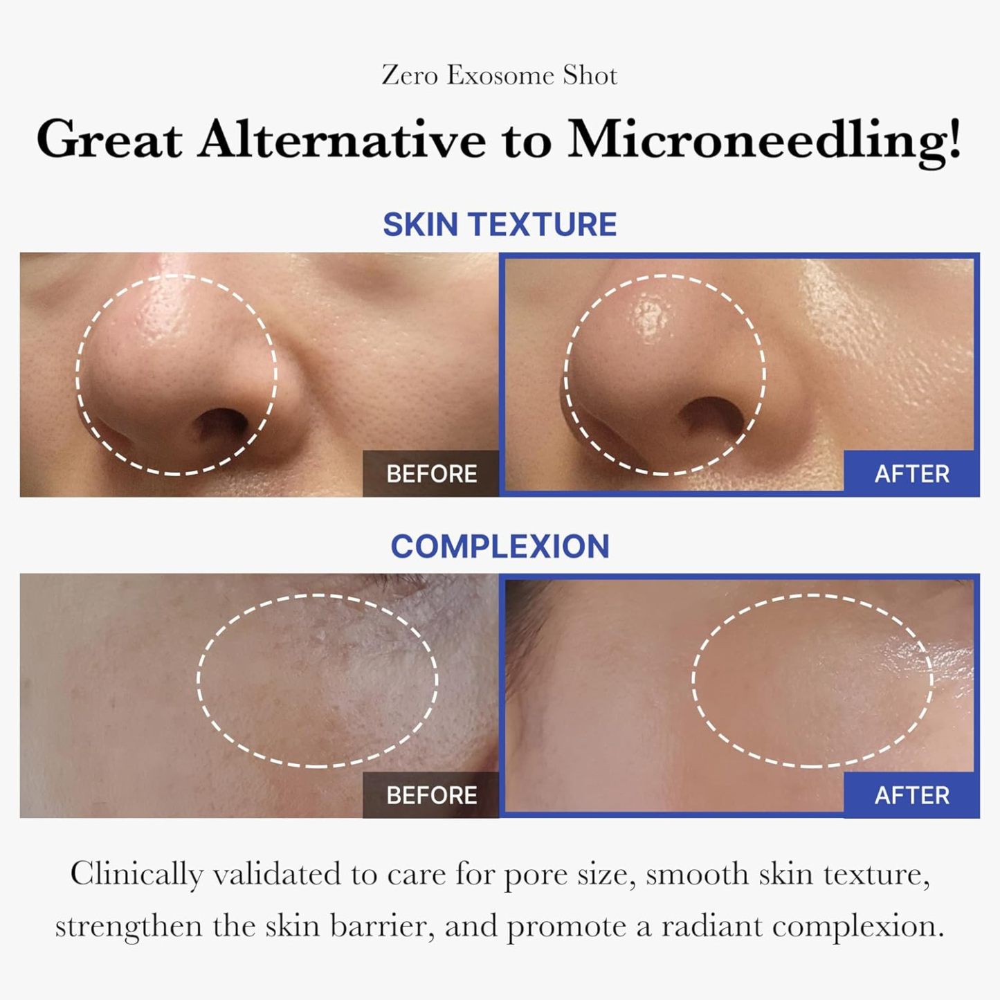 Zero Exosome Spicule Shot Serum 2000 mild Skincare Aha Ampoule