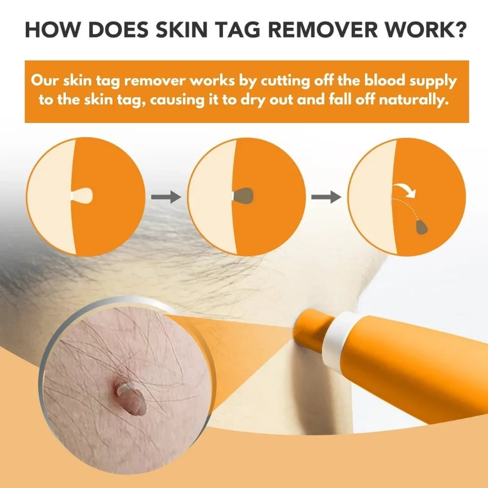 How ClearSkin Pro Skin Tag Remover works by cutting off blood supply to remove skin tags naturally at home