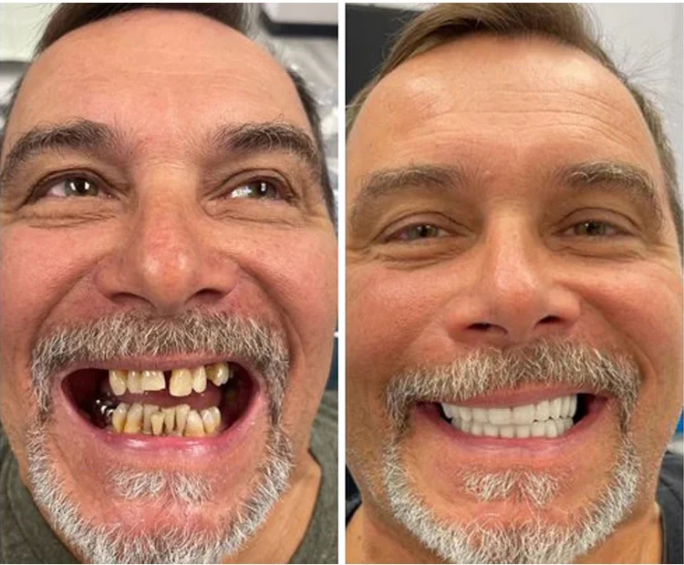 🦷  Fit Full Functional DenturesMake you more confident