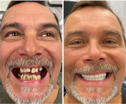🦷  Fit Full Functional DenturesMake you more confident