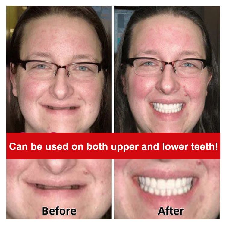 Denture Retouching Beauty Kit - No glue, no boiling required—securely adheres to your mouth.