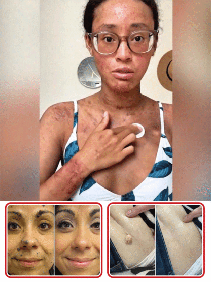 ✨Painless and non-invasive, a substitute for cosmetic procedures, can be done at home. Say goodbye to surgery, lasers, and cryotherapy. 0 pain, 0 scars, and no recovery period. ✅