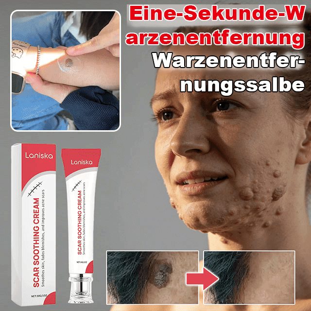 【Eine-Sekunde-Warzenentfernung】Warzenentfernungssalbe