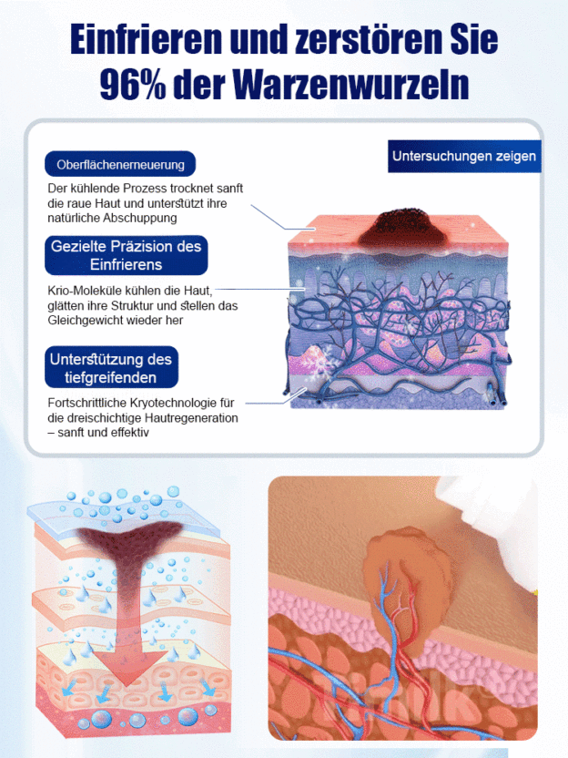 Frostspray – 96% Warzenwurzelentfernung, schmerzfrei & narbenfrei, Versand innerhalb Deutschlands.